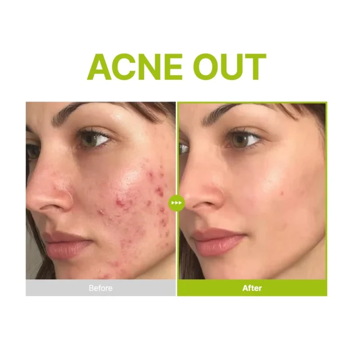 Purito-Azelaic-Acid-10-Kojic-Tea-Tree-Serum-2.webp