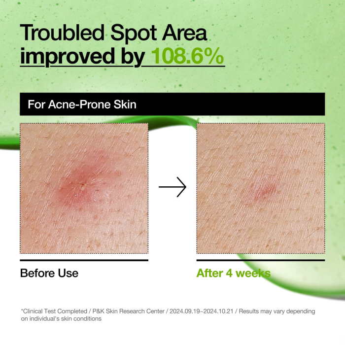 Anua-Azelaic-Acid-10-Hyaluron-Redness-Soothing-Serum-4.webp