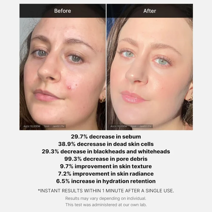 Medicube-Red-Acne-Succinic-Acid-Peel-3.webp
